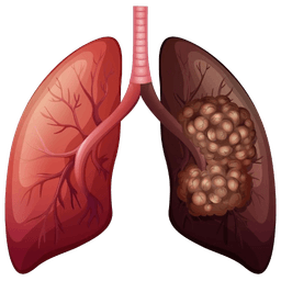 Lung Cancer