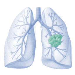 Lung Carcinoid Tumor
