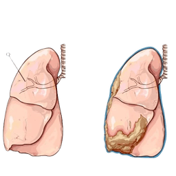 Malignant Mesothelioma