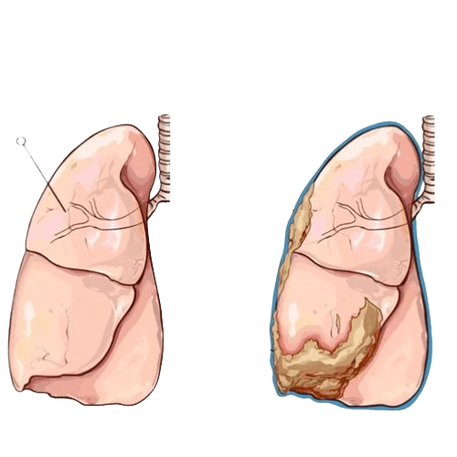 Malignant Mesothelioma