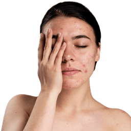 Melasma