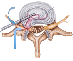Microdiscectomy