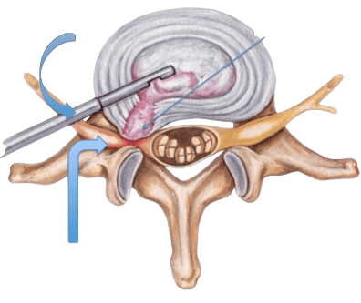Microdiscectomy