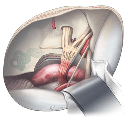 Microvascular Decompression-MVD