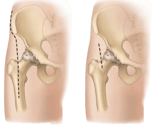 Minimally Invasive Hip Resurfacing
