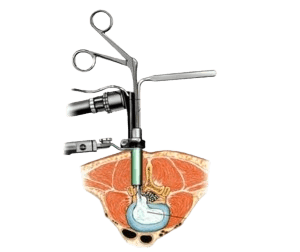 Minimally Invasive Spine Surgery