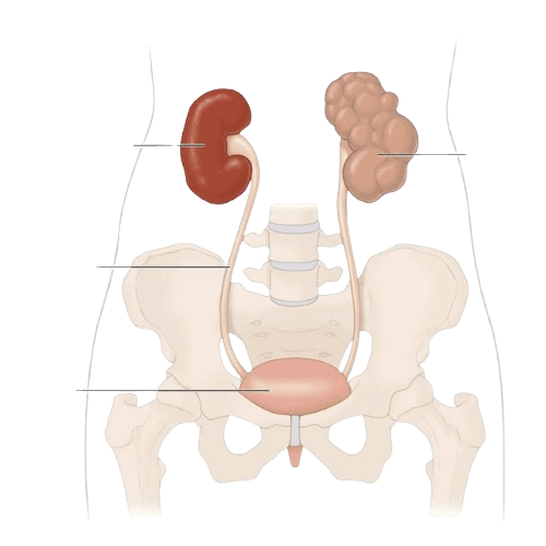 Multicystic Dysplastic Kidney (MCDK)