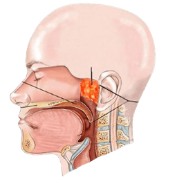 Nasopharyngeal Cancer