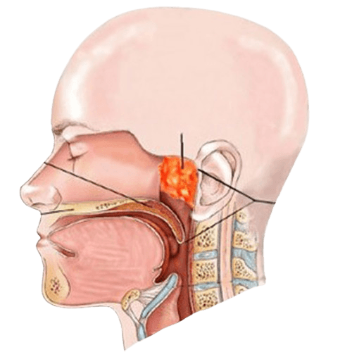 Nasopharyngeal Cancer
