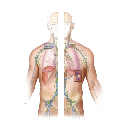 Non-Hodgkin Lymphoma-NHL