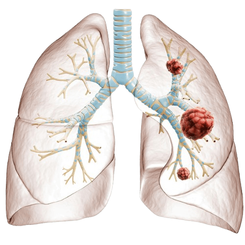 سرطان الرئة ذو الخلايا غير الصغيرة (NSCLC)