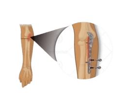Open Reduction of Fracture