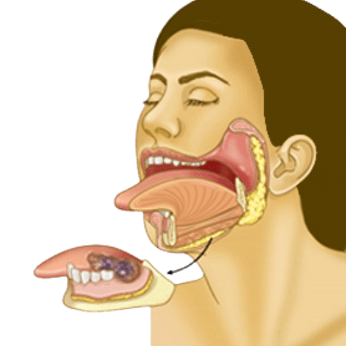 Oral Cancer- Surgical