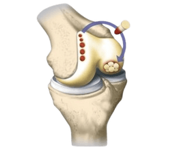 Osteochondral Autografting Mosaicplasty Surgery