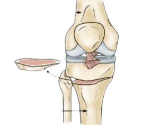 Osteotomy