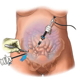 Ovarian Cancer Surgery