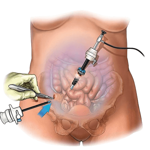 Ovarian Cancer Surgery