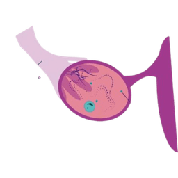 Ovarian Germ Cell Tumor