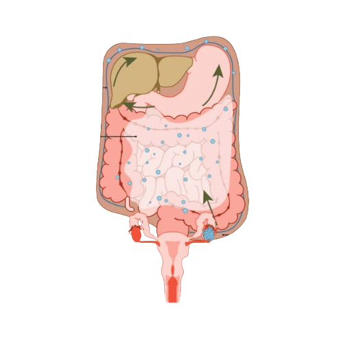 Ovarian Primary Peritoneal Cancer