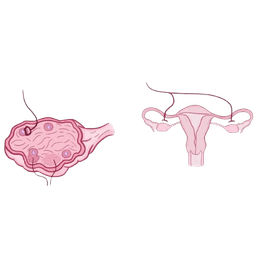 Ovarian Sex Cord Stromal Tumor