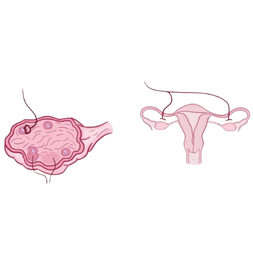 Ovarian Sex Cord Stromal Tumor