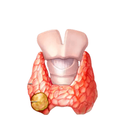 Papillary Thyroid Cancer