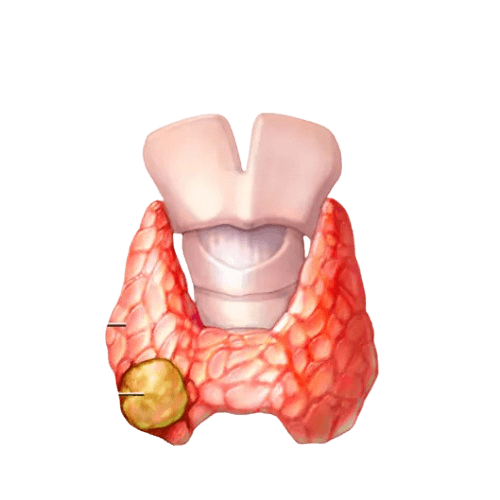 Papillary Thyroid Cancer