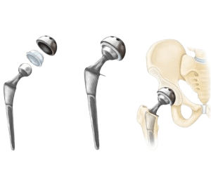 Partial Hip Replacement (Unilateral Hip Replacement)