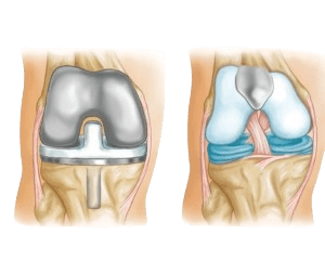 PatelloFemoral Replacement