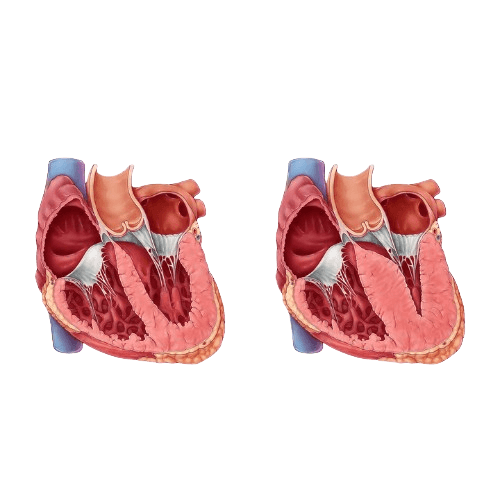 Pediatric Cardiomyopathy