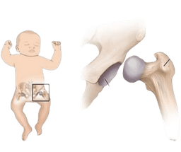 Pediatric Hip Dysplasia Surgery