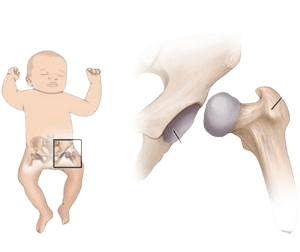 Pediatric Hip Dysplasia Surgery