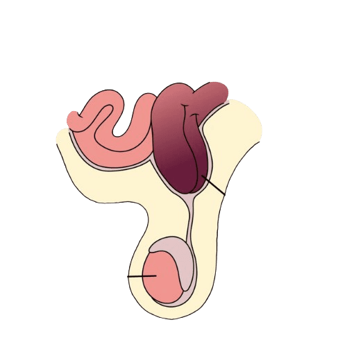 Pediatric Inguinal Hernia Repair