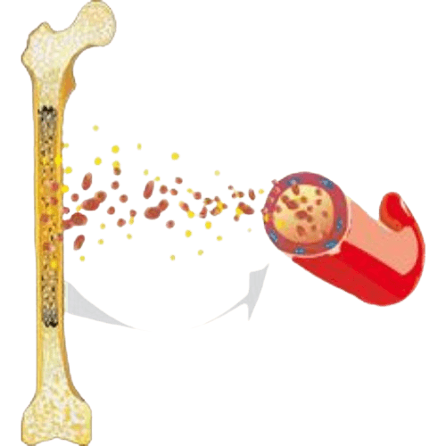 Pediatric Myelodysplastic Syndrome (MDS)