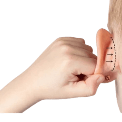 Pediatric Otoplasty