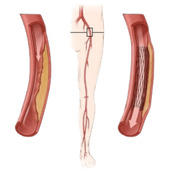 Peripheral Angioplasty