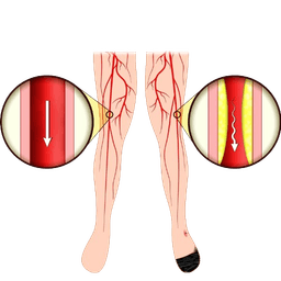 Peripheral Artery Disease