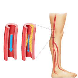 Peripheral Vascular Surgery