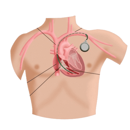 Permanent Pacemaker Implant Single Chamber
