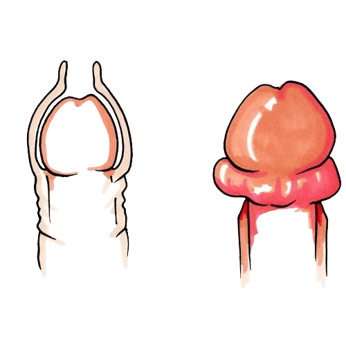 Phimosis & Paraphimosis