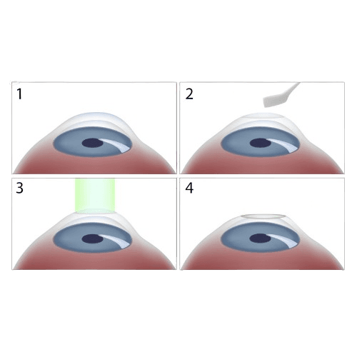 Photorefractive Keratectomy (PRK)