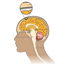 Pineal Region Tumors