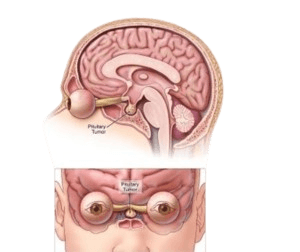Pituitary Tumor