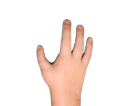 Pollicization Surgery