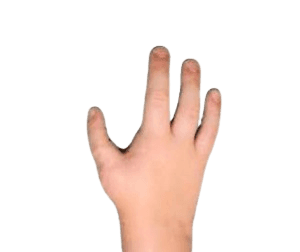 Pollicization Surgery