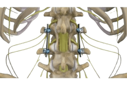 Posterior Lumbar Interbody Fusion-PLIF