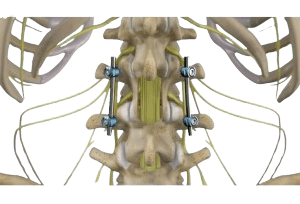 Posterior Lumbar Interbody Fusion-PLIF