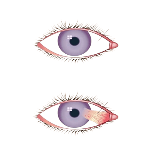 Pterygium Removal Surgery