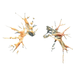 Pulmonary Thromboendarterectomy (PTE)
