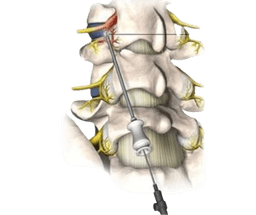 Radiofrequency Rhizotomy- Neurotomy